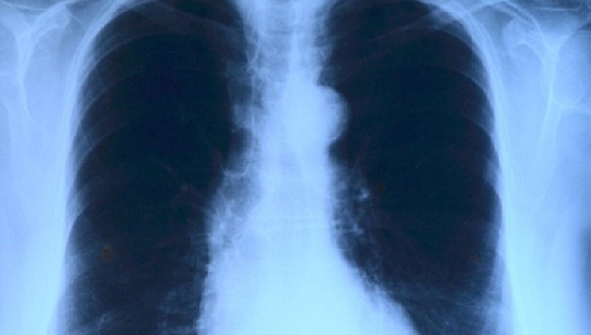 Tumore del polmone